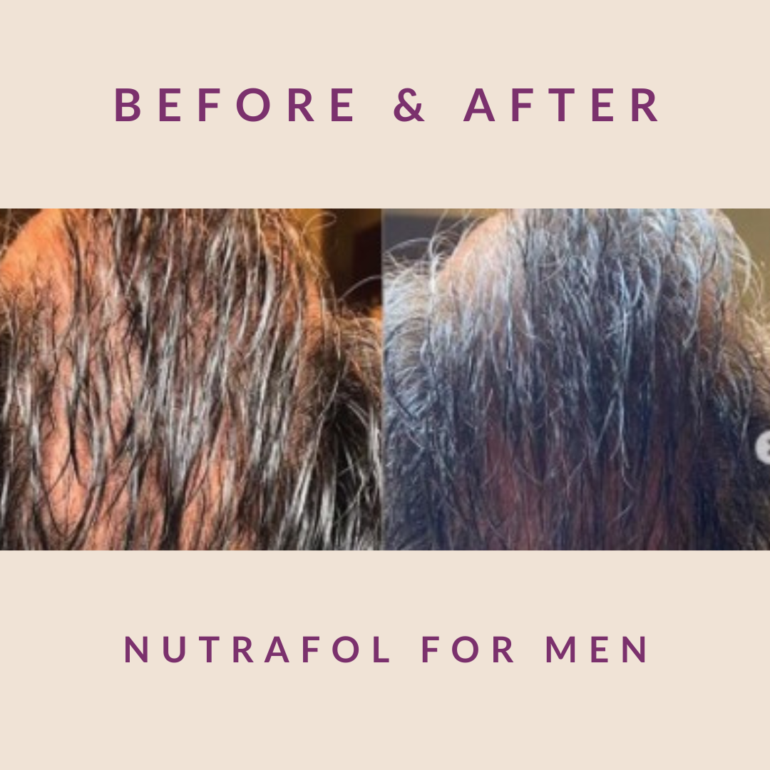 Nutrafol For Men Hair Restoration For Men In Nyc Dr Jennifer Levine 0629