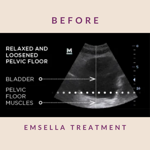 EMSELLA® Treatment
