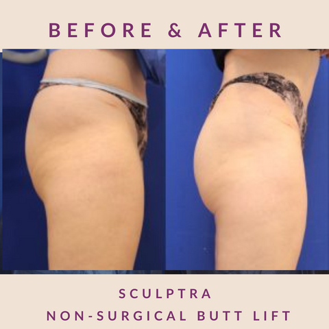 SCULPTRA® Non-Surgical Butt Lift