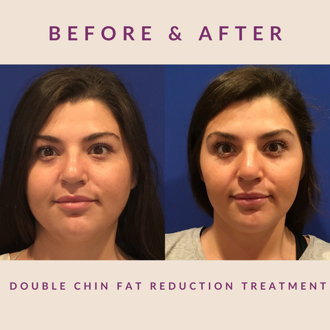 KYBELLA® INJECTABLE FAT REDUCTION